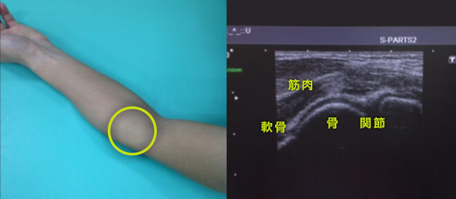 超音波検査 肘の見え方