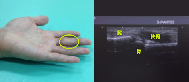 超音波検査 指の見え方