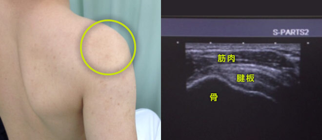 超音波検査 肩の見え方